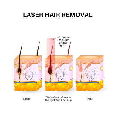 Dispositif d' épilation laser portable 810nm Machine d' épilation permanente pour femme
