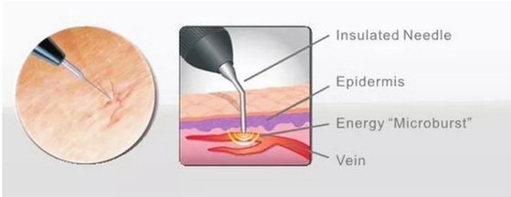 Salon de beauté machine laser à diode 980nm pour soulager la douleur / traitement vasculaire