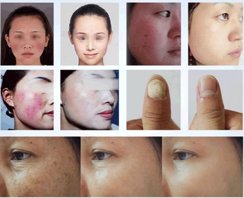 Salon de beauté machine laser à diode 980nm pour soulager la douleur / traitement vasculaire