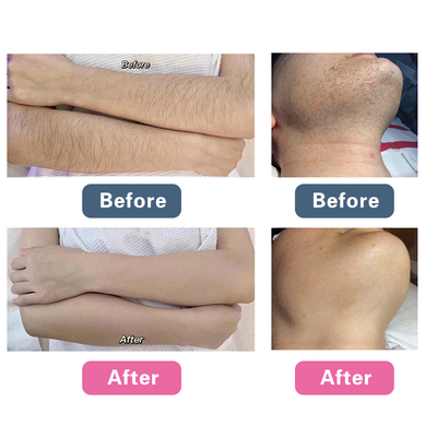 La machine de rajeunissement du visage au laser de picosecondes, la machine de retrait de tatouage Q.