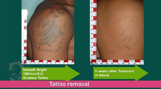 La machine de rajeunissement du visage au laser de picosecondes, la machine de retrait de tatouage Q.