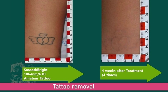 Commercial Q commuté Laser machine à enlever les tatouages 1064nm 532nm 755nm