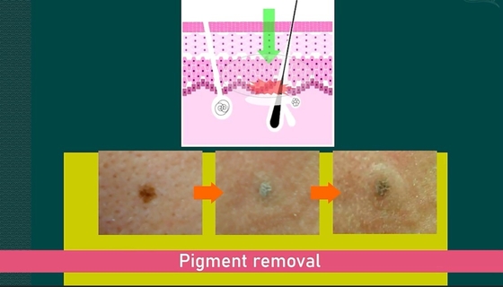 Machine laser à picosecondes de 755 nm pour l' épilation / l' épilation de tatouage