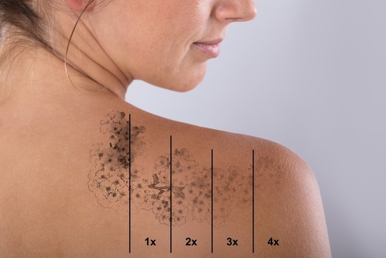 Opte 585nm machine laser de picosecondes pour l' élimination des tatouages