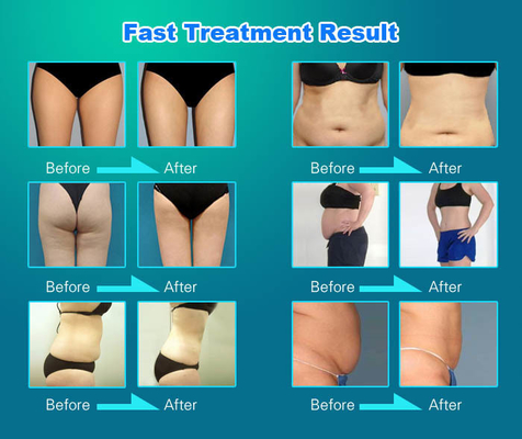 5 en 1 machine de minceur Vela, machine de réduction de cellulite Velashape pour contourner le visage / le corps