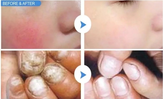 15W 30W machine d'élimination vasculaire au laser pour le traitement des ongles des pieds / rajeunissement de la peau au laser chaud