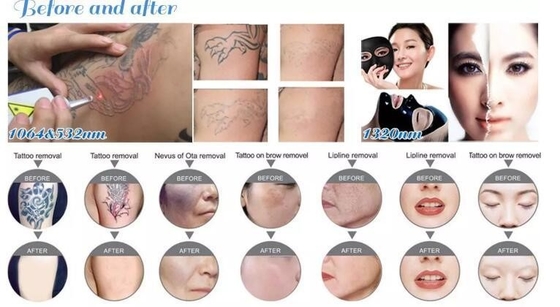 Machine à éliminer les tatouages au laser Nd YAG Portable 1064nm 532nm 1320nm Longueur d'onde