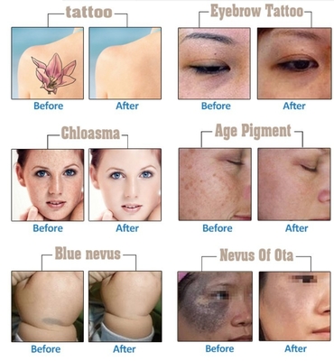 Q Switch Nd YAG Laser Machine d' élimination des tatouages 1064nm 532nm 1320nm 2 ans de garantie