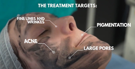 Machine laser Yag multifonctionnelle Q Switch ND pour l' élimination des tatouages ou la pigmentation