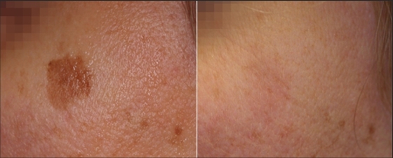 3 en 1 Q Switch ND Yag Laser Machine Détachement de tatouage Services OEM ODM