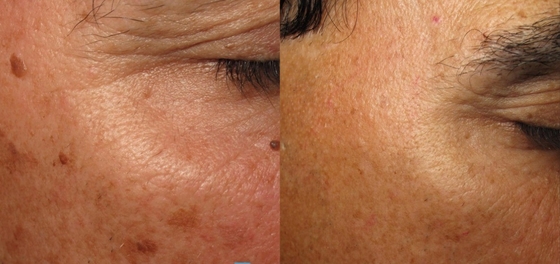 3 en 1 Q Switch ND Yag Laser Machine Détachement de tatouage Services OEM ODM