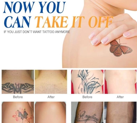 Machine laser Yag personnalisée Q Switch ND pour l' élimination des tatouages / traitement de l' acné