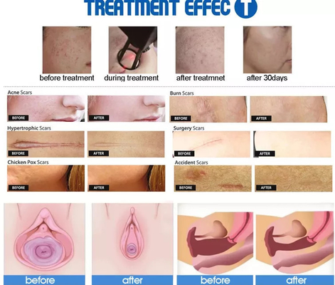 Machine fractionnée laser portable 40W pour salon de beauté 2 ans de garantie