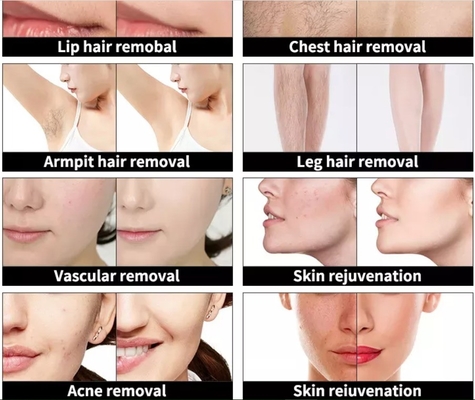 4 en 1 machine de beauté multifonctionnelle à trois longueurs d'onde laser pour éliminer les poils de tatouage